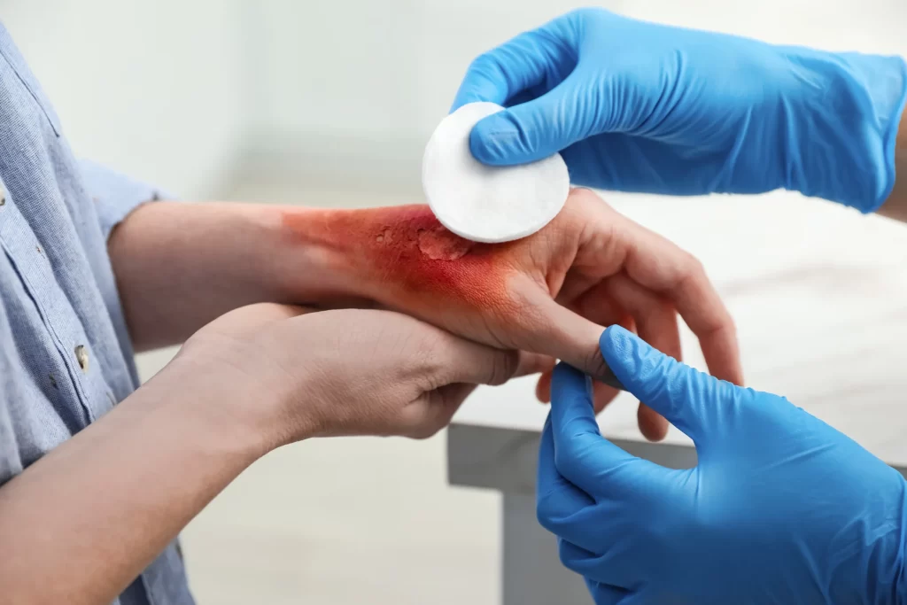 Burn Injury Lawyer in Michigan
